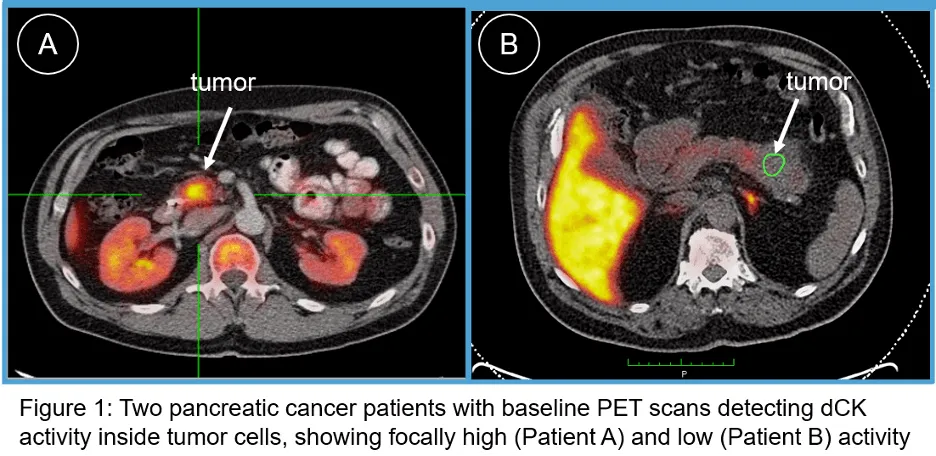 Two PET scan images show pancreatic tumors: Patient A (left) with high dCK activity and Patient B (right) with low activity, both tumors indicated by arrows and circled on cross-sectional abdominal scans.