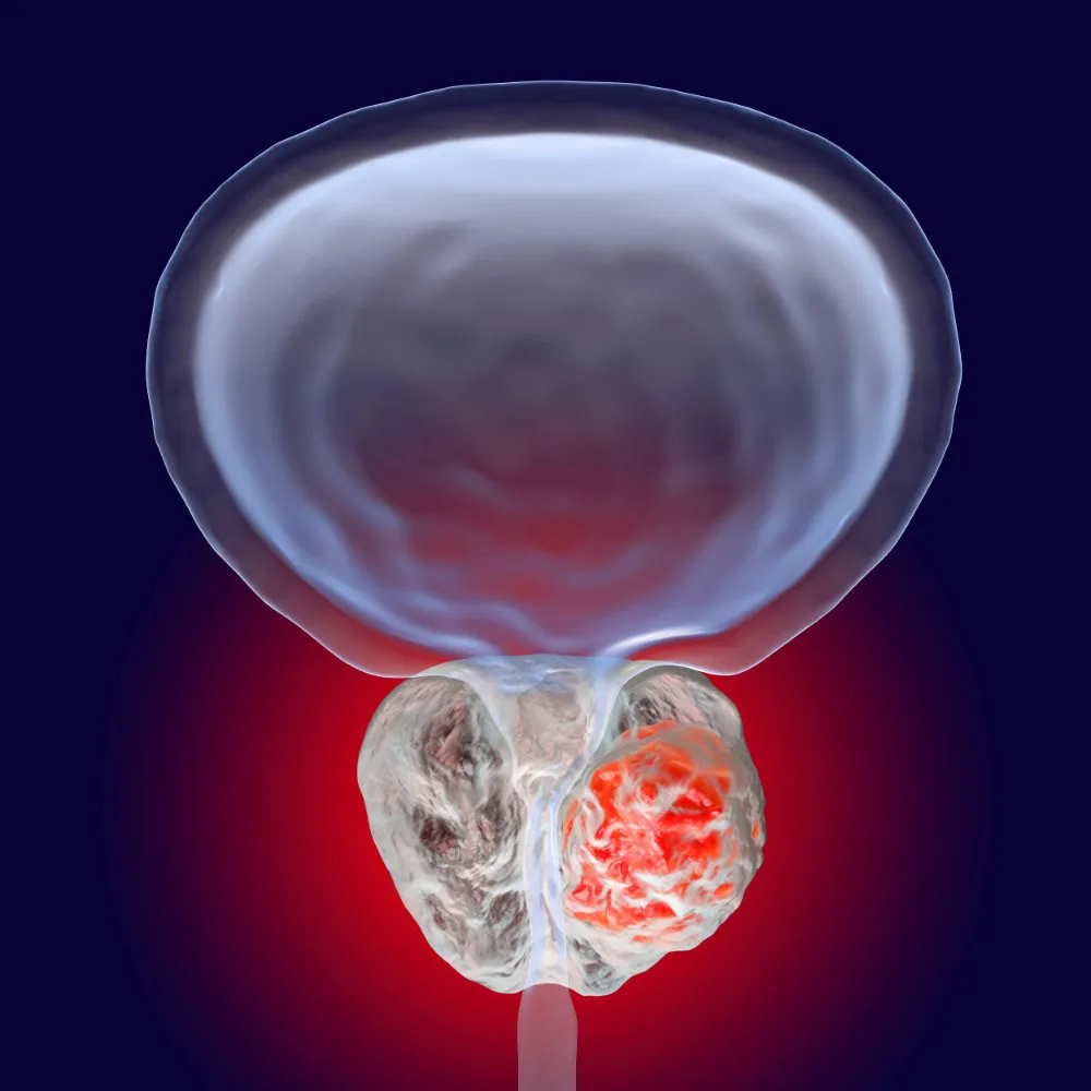 Figure 1. Artist interpretation of a growing prostate tumor.