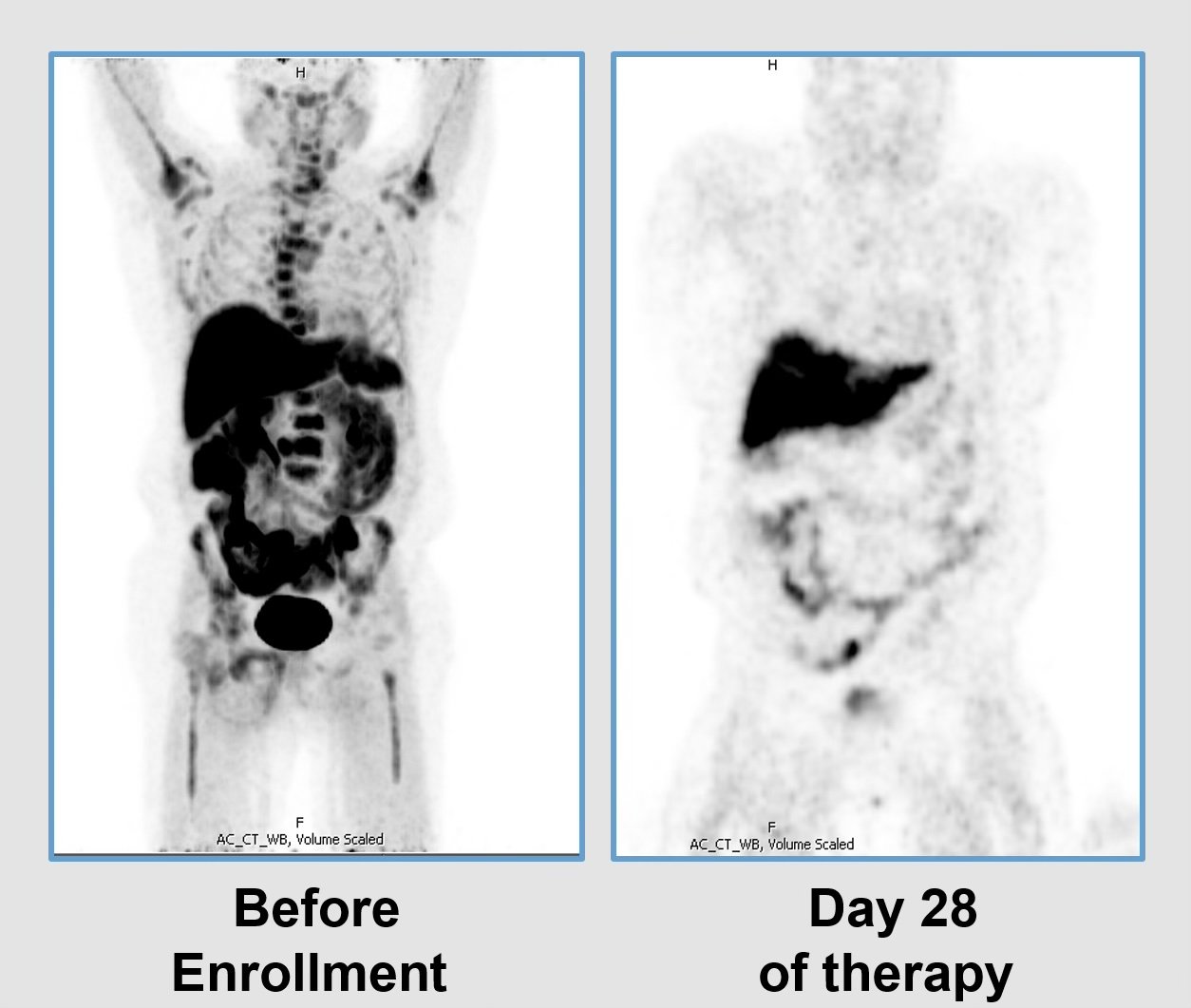 Two PET scans show a human body: left image labeled Before Enrollment with dark areas in the liver and pelvis; right image, Day 28 of therapy, shows reduced dark areas, indicating treatment response.